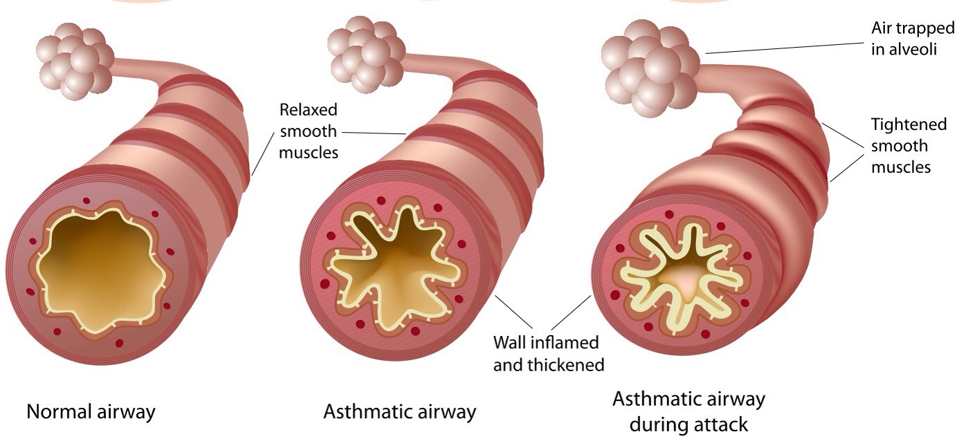 Diagram of asthmatic airway