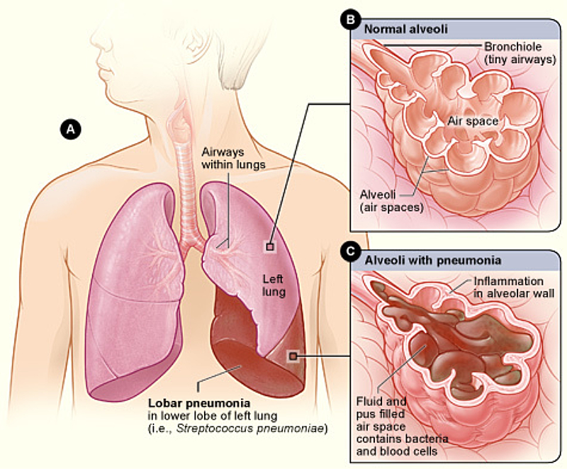 Lobar Pneumonia Illustrated