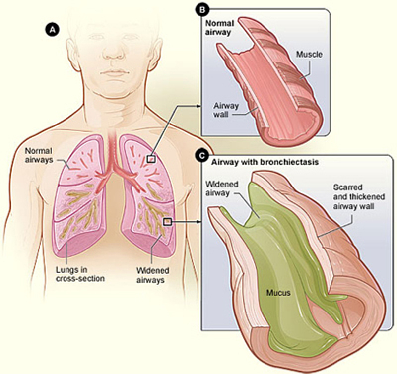 Bronchiectasis Asthma Foundation Nz